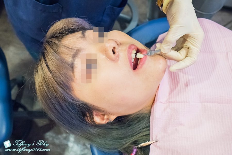 [台北牙醫診所推薦]悅庭牙醫診所/當天擁有全瓷冠美齒/還有導引式植牙提高成功率讓妳安心又放心