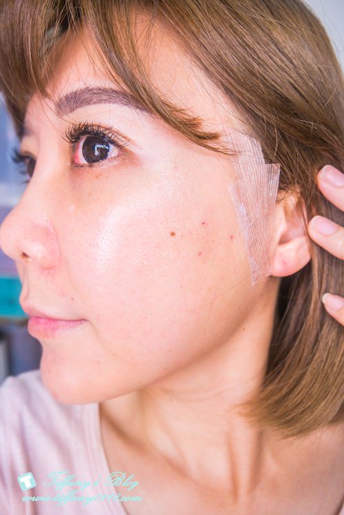 [醫美]塑立愛立體線(鈴鐺線)讓妳重拾年輕臉龐/上立皮膚科診所